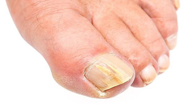 ciuperca unghiei unghiei complet afectate